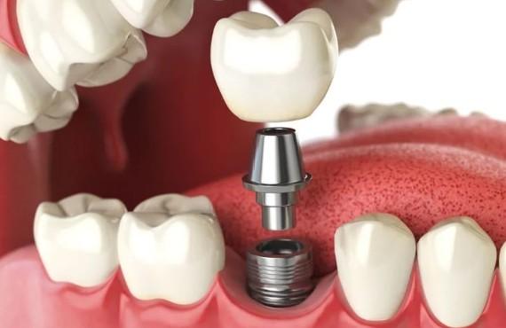Dental implant used in biointerface and integration studies to evaluate surface–tissue interactions, osseointegration, and biomaterial performance