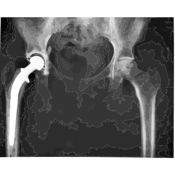X-ray image of hip implant used to assess implant positioning, bone integration, and long-term biomaterial performance in orthopedic applications