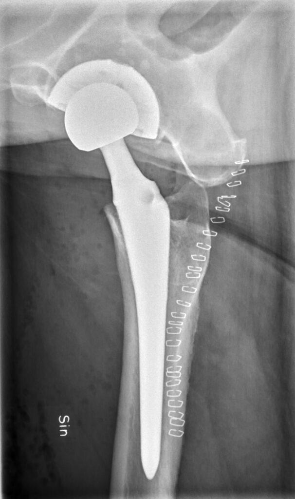 Integration of Hip implant with the bone